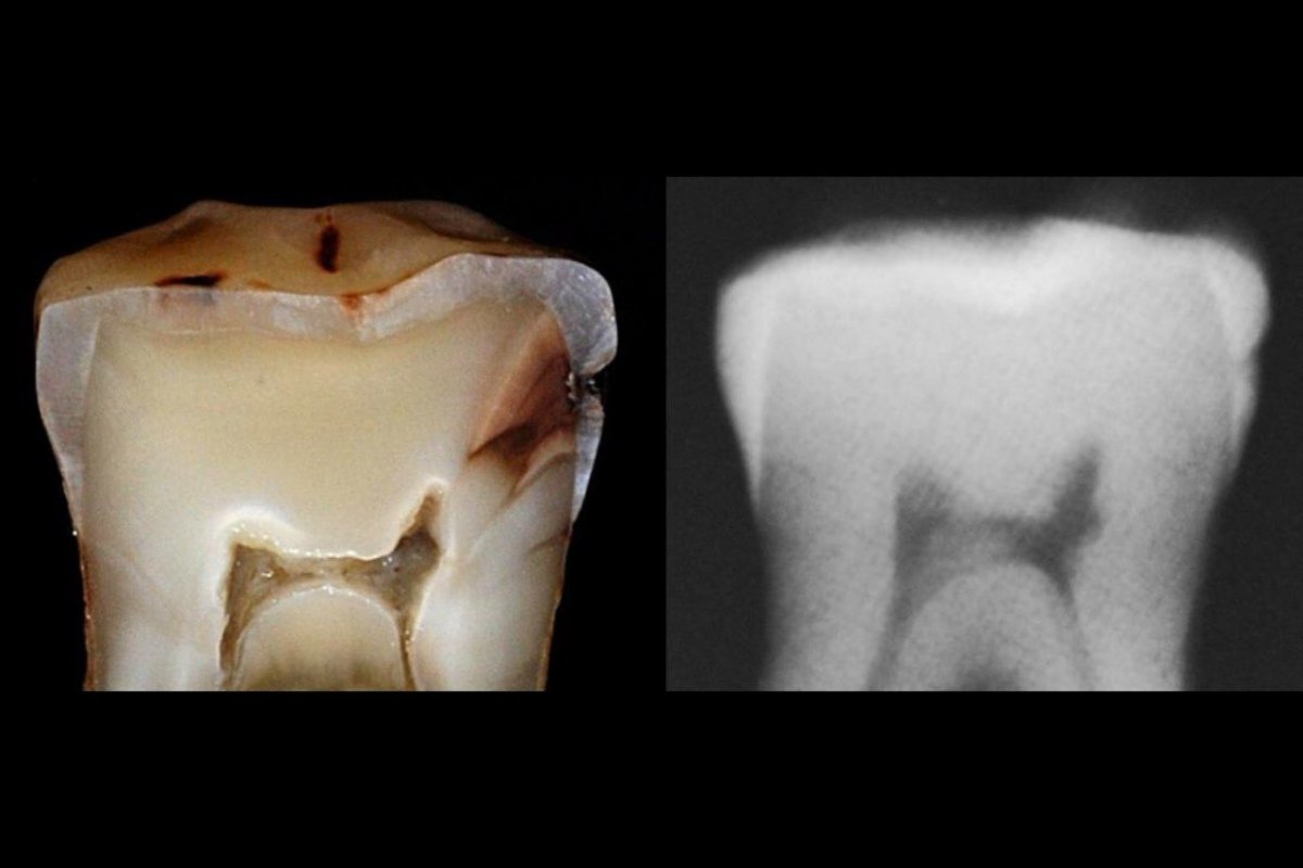 What is tooth decay? How does it occur? Can it be prevented?